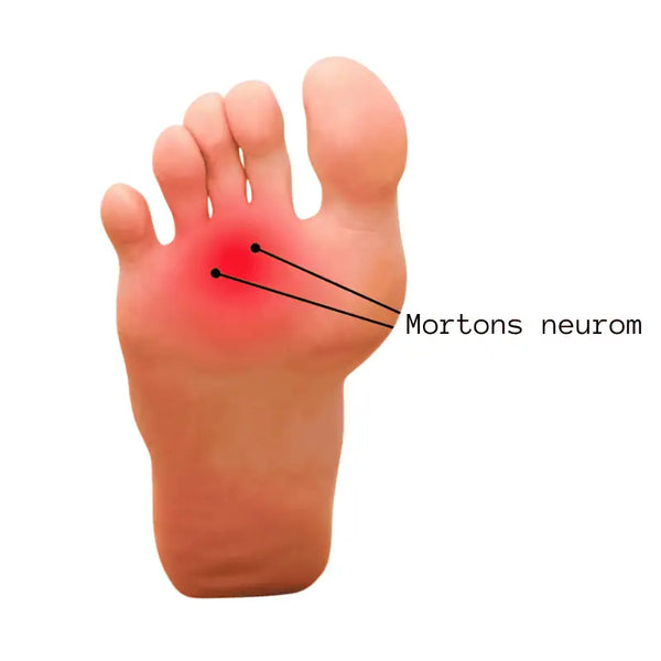Mortons Neurom